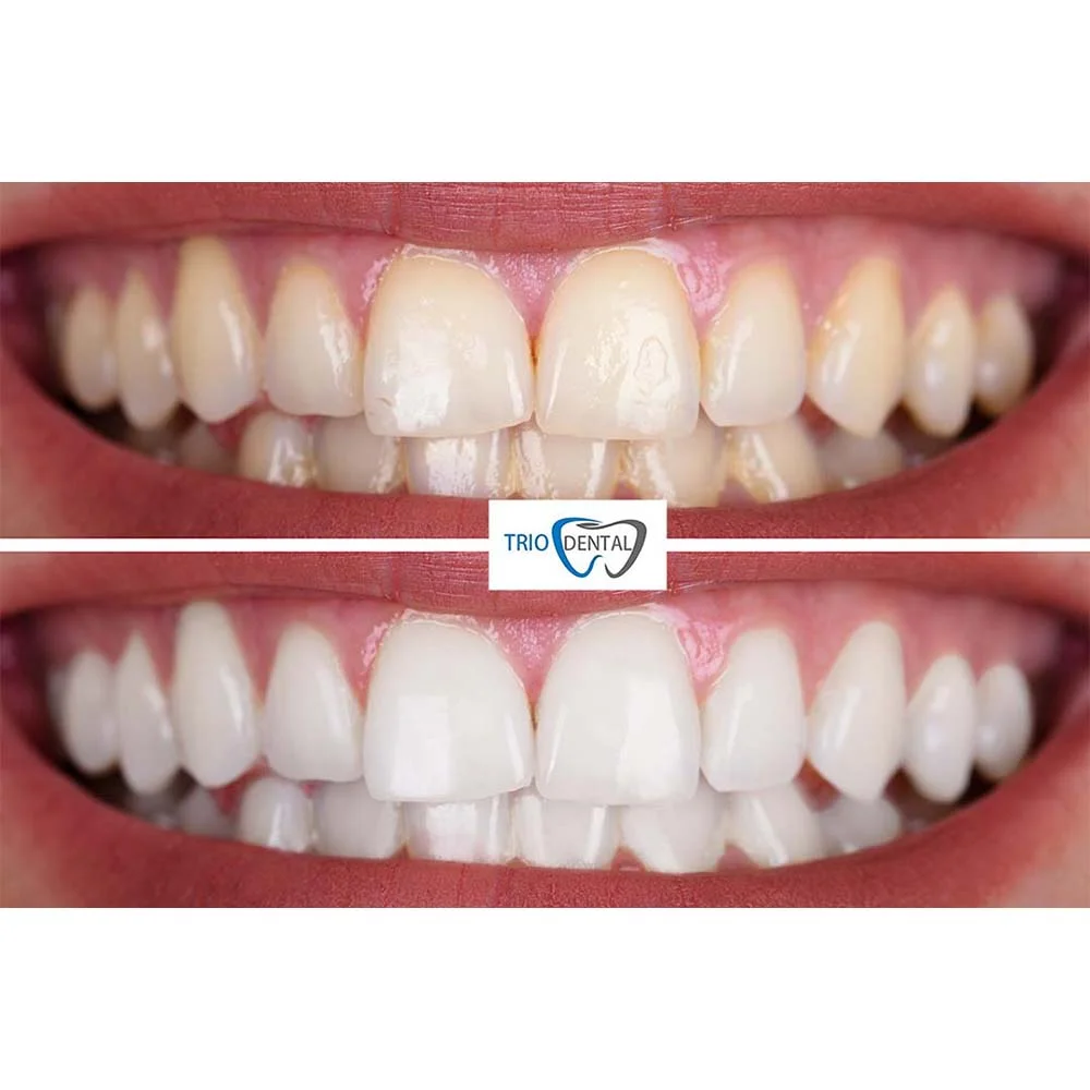 Photo comparison of teeth before and after whitening procedure.