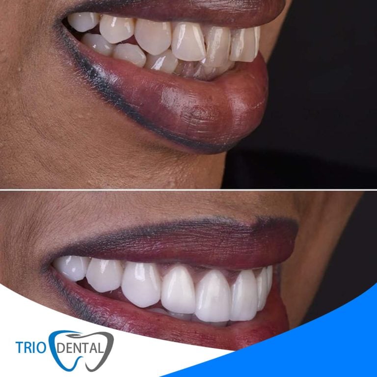 Kurora zirkoni mbi implante, para dhe pas, Trio Dental Center, Tiranë