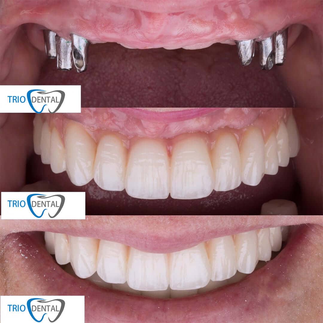 Prima e dopo: arcata superiore su sei impianti dentali, Trio Dental Center Tirana