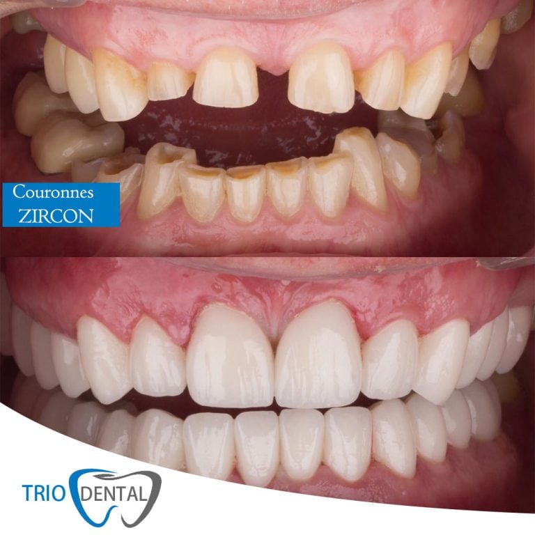 Before and after zirconia crowns: gaps and worn upper teeth, then a full row of white zirconia crowns