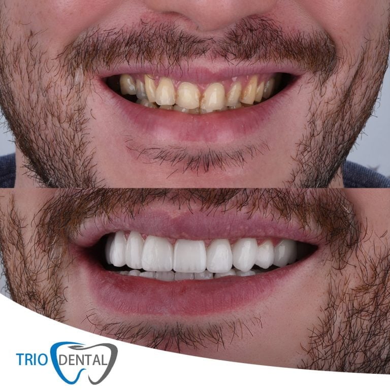 Pacient gjatë vendosjes së kurorave përfundimtare mbi implante në Trio Dental Center, Tiranë
