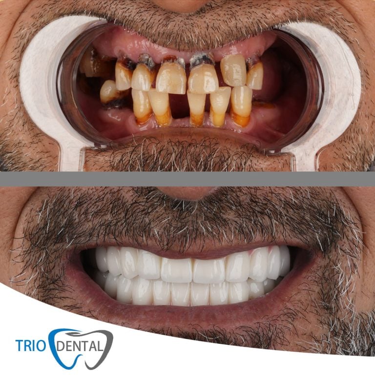 Para dhe pas: karies i avancuar dhe molarë të munguar, të restauruar me implante dhe kurora, Trio Dental Center, Tiranë