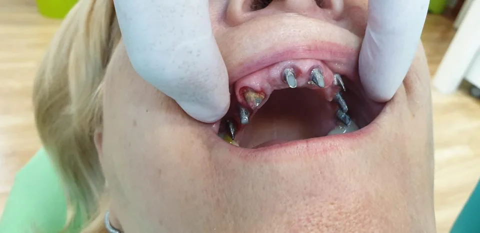 Tenir une personne bouche ouverte pour mettre en valeur les vis des implants dentaires avant de placer des implants de qualité supérieure.