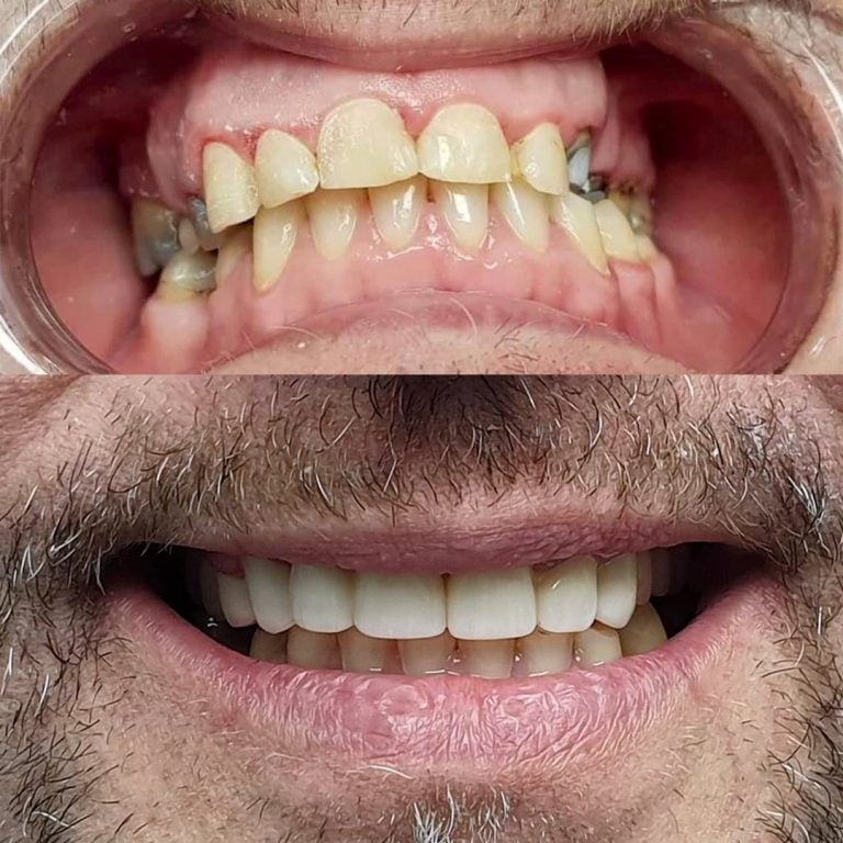 Para dhe pas: dhëmbë të përparmë të konsumuar, të zëvendësuar me implante dhe kurora, Trio Dental Center, Tiranë