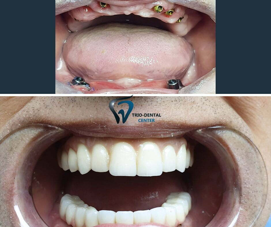 Showing an amazing transformation using immediate loading implantology in Albania.
