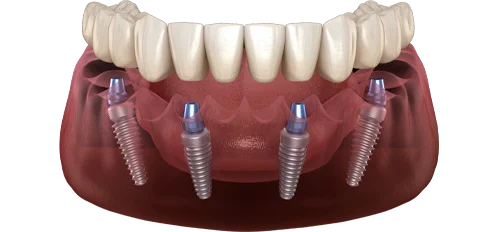 Illustrative image of all on 4 dental implants with animated results. 