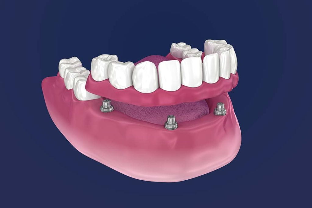 Animated photo showing the bottom overdenture. How easy it is done in 4 screws.