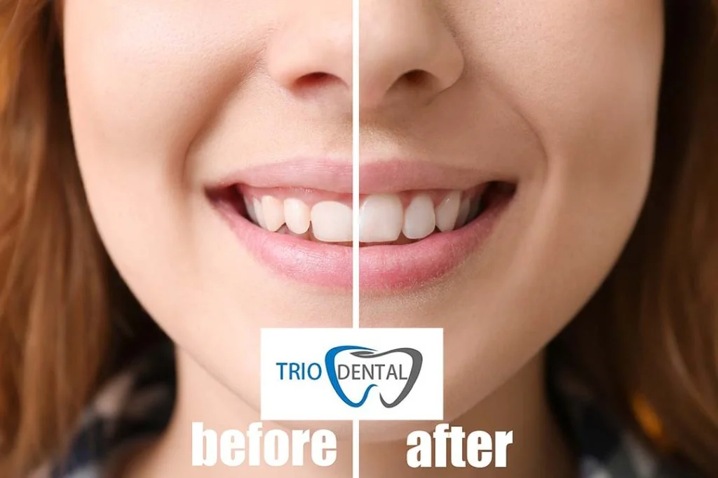 Photo showing a girl before and after her gum correction Albania treatment at Trio Dental Center.