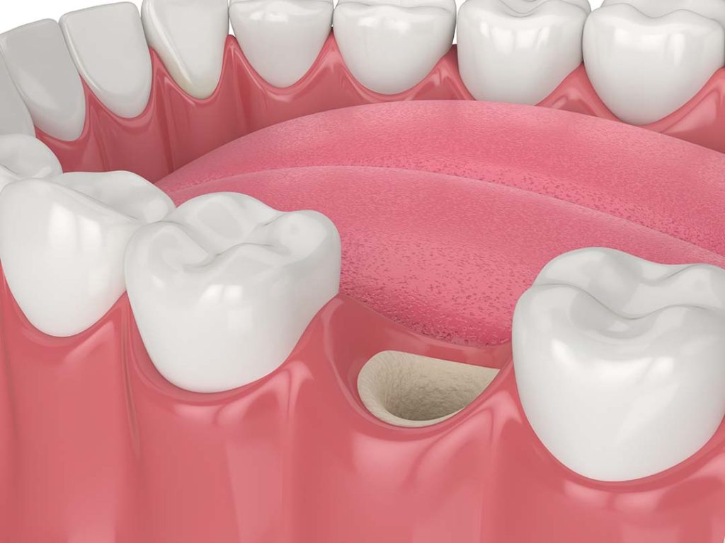 Un innesto osseo riempito pronto per posizionare l'impianto per sostituire il dente mancante.