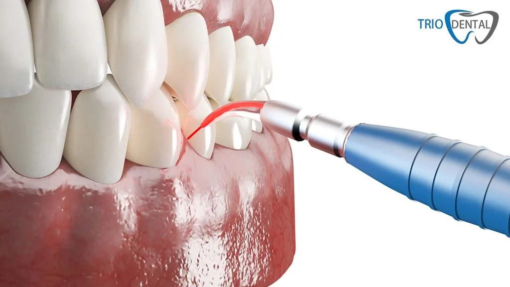 Image showing how correcting gums can be done.