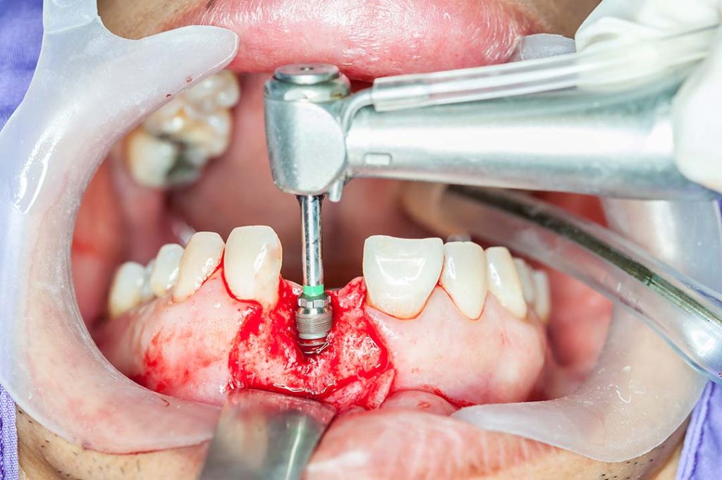 Una foto nel mezzo del posizionamento immediato dell'impianto per la sostituzione di un dente mancante.