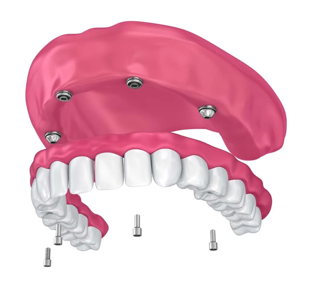 Animated photo of an implant overdenture from a dental clinic in Albania.