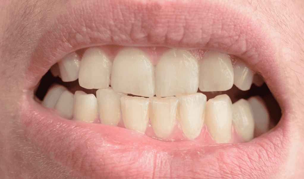 Immagine che illustra i problemi che possono essere risolti dalla migliore clinica per le faccette dentali in Albania.