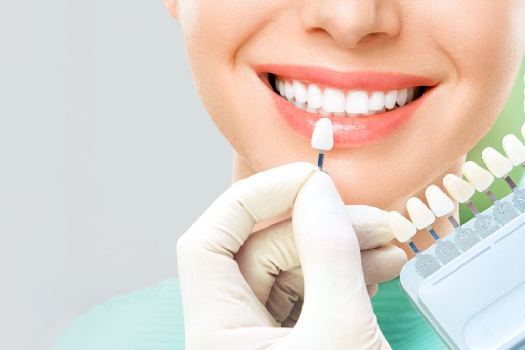 Immagine che illustra i vantaggi delle faccette dentali presso la migliore clinica per faccette dentali in Albania.