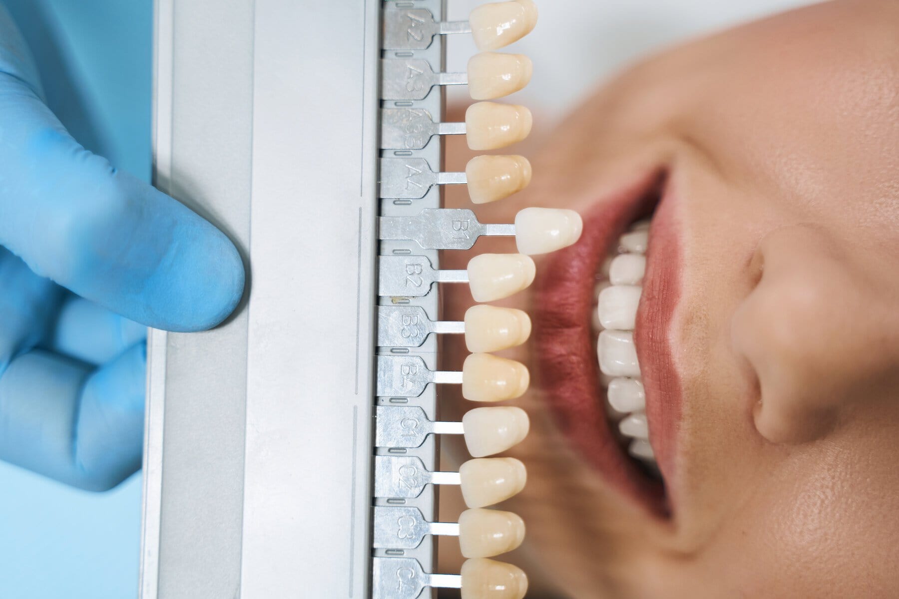 Foto që ilustron fasetat dentare nga Trio Dental Center, klinika më e mirë për fasetat dentare në Shqipëri.