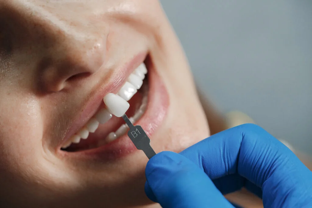 Image illustrant les meilleures facettes dentaires en Albanie.