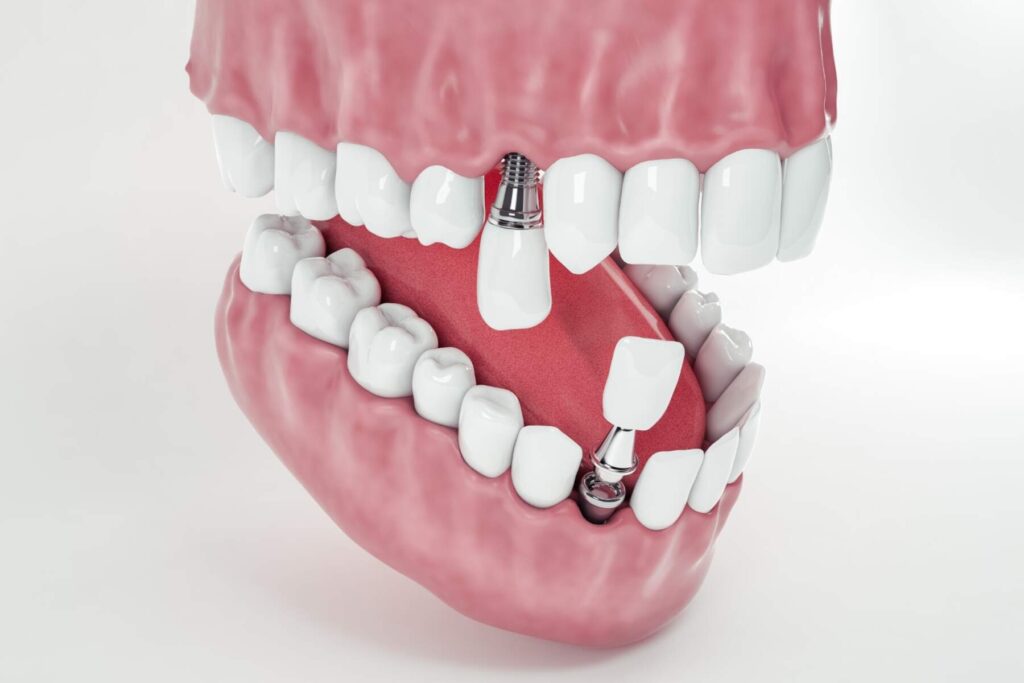 Image illustrant des implants dentaires permanents en Albanie
