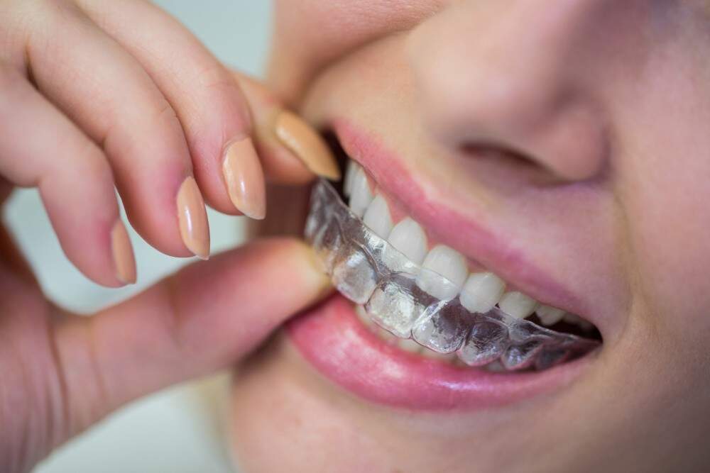 Appareils dentaires transparents pour adultes