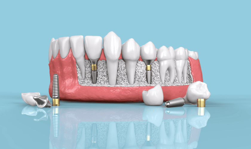 Schema di impianto dentale che mostra la sostituzione del dente e la struttura interna su sfondo blu.