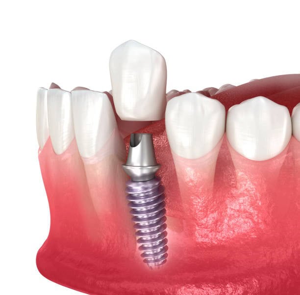 Illustrazione dell'impianto dentale che mostra il posizionamento della vite e della corona nella gengiva.