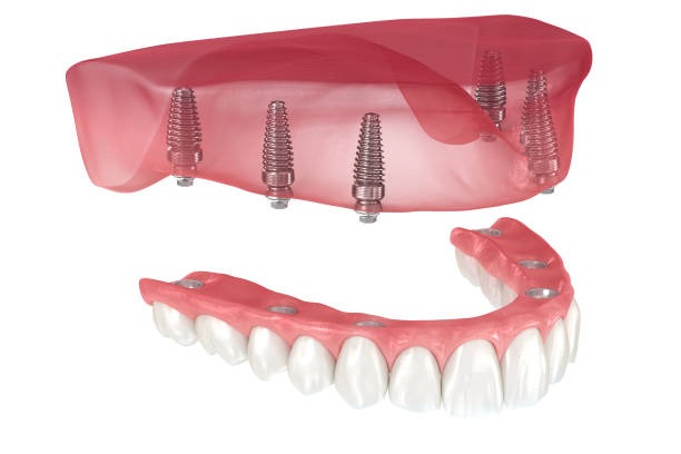 Dental implant illustration showing jawbone with implants and dentures for oral surgery and tooth restoration.