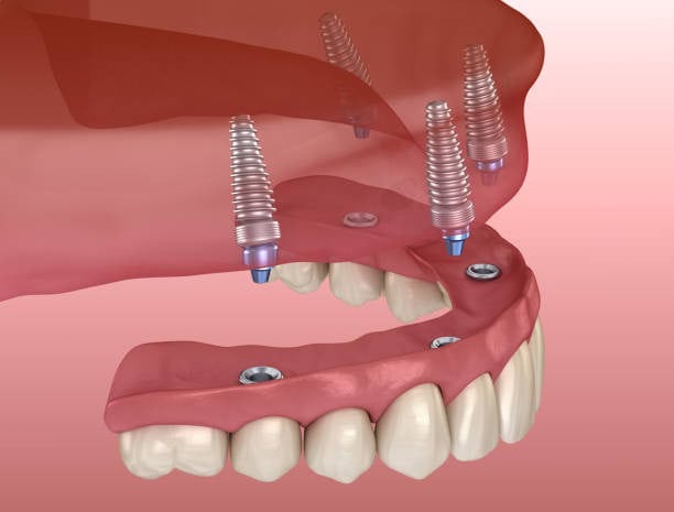 Illustration of dental implants with overdenture in gums, showcasing oral health procedure.
