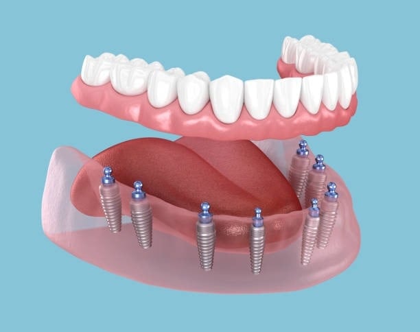 Dental implant illustration showing full set of teeth on gums with titanium posts against a blue background.