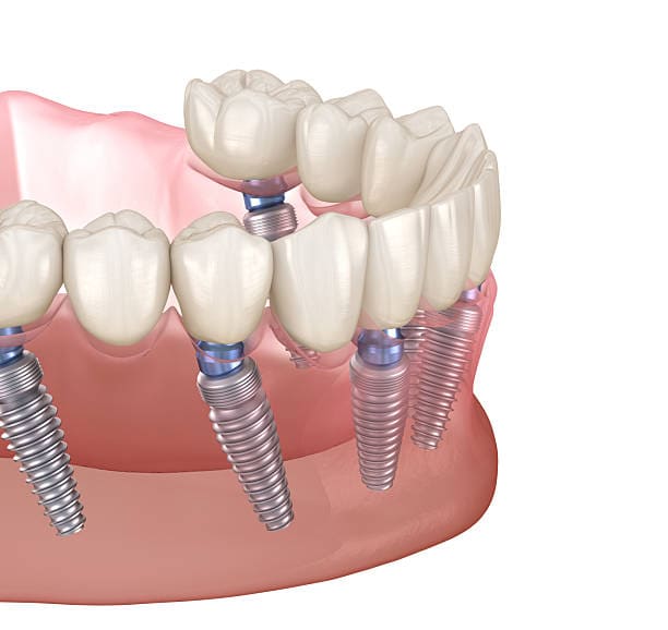 Illustrazione degli impianti dentali che mostra i denti artificiali ancorati all'osso mascellare.