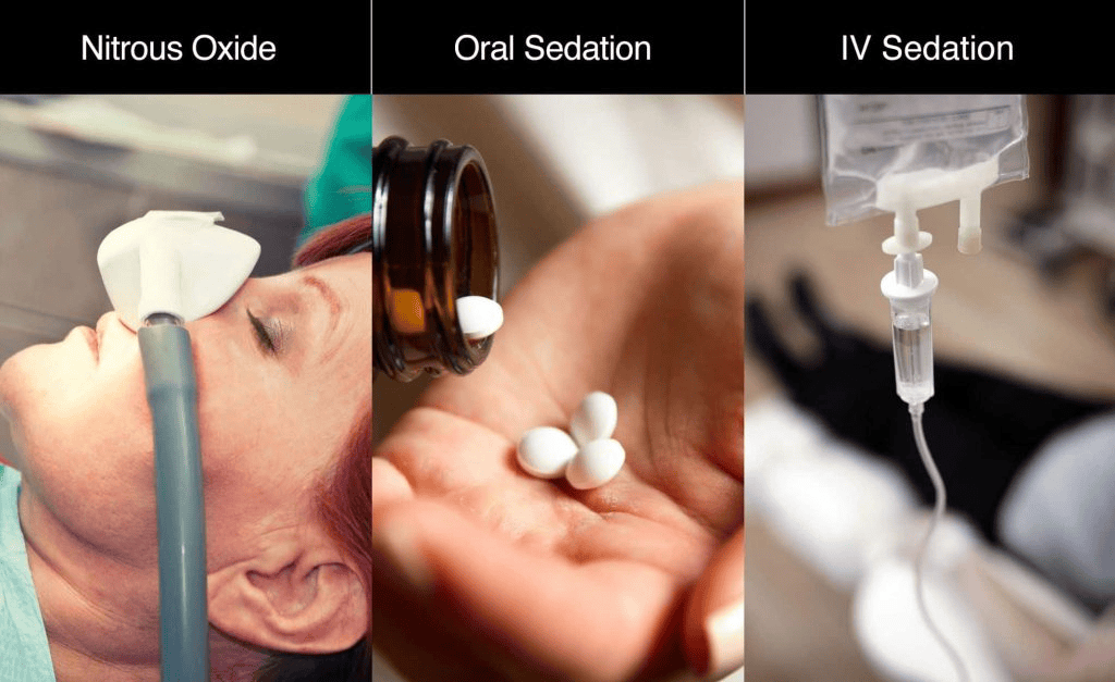 Comparación de los tipos de sedación dental: óxido nitroso, píldoras orales y goteo intravenoso para la relajación del paciente y el alivio de la ansiedad.