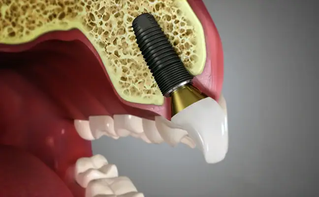 Illustrazione di un impianto dentale nell'osso mascellare che mostra la struttura dell'impianto e il posizionamento del dente per il ripristino della salute orale.