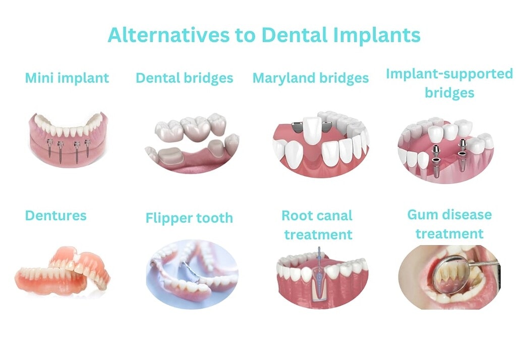 Esplora otto alternative agli impianti dentali, tra cui mini impianti, ponti dentali e trattamenti canalari.