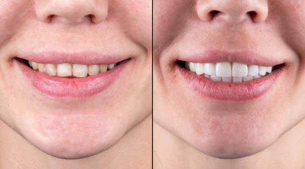 Before and after teeth whitening comparison, showing significant improvement in dental aesthetics and smile brightness.