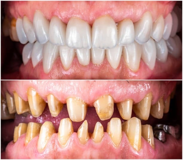 Prima e dopo la trasformazione dentale che mostra un miglioramento dell'allineamento e del colore dei denti.