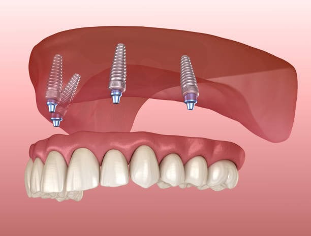 Ilustrim 3D i implanteve dentare që mbështesin një protezë all-on-4 për nofullën e sipërme, duke treguar konceptin e zëvendësimit të dhëmbëve.