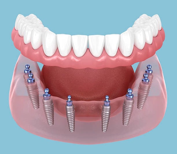 Model dhëmbor i nofullës së poshtme me proteza dhe implante dentare në sfond blu.