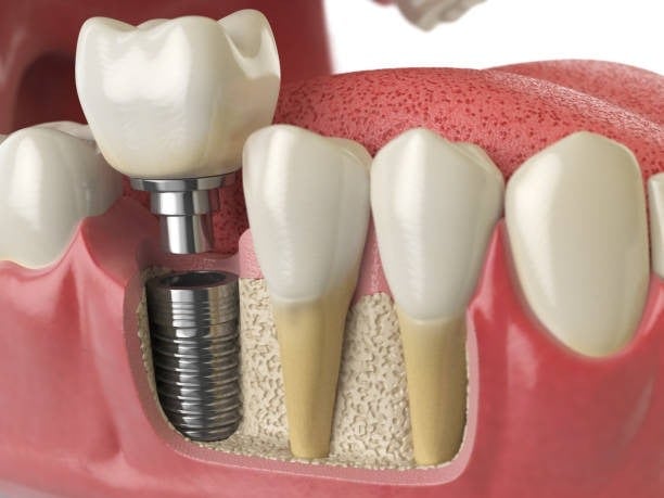 Diagramma di impianto dentale che mostra corona, abutment e vite nell'osso mascellare per la sostituzione di un dente.
