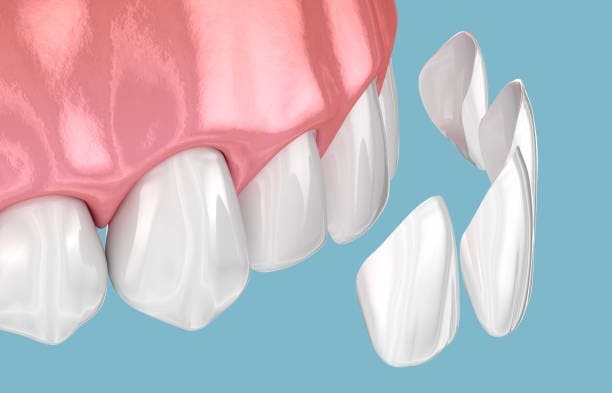 Ilustrim i veneerëve dentarë që tregon aplikimin në dhëmbë, duke përmirësuar pamjen dhe ngjyrën.