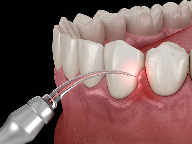 Tratamiento con láser dental en bolsa gingival, ayudando al cuidado periodontal y la restauración de la salud bucal, primer plano.