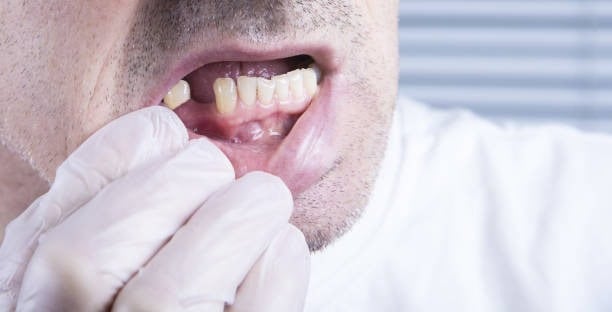 Hombre con diente faltante en primer plano, usando un guante, examinando dientes, resaltando problemas de salud y cuidado dental.