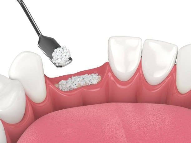 Ilustración de injerto óseo dental, mostrando gránulos colocándose entre los dientes para tratamiento periodontal.