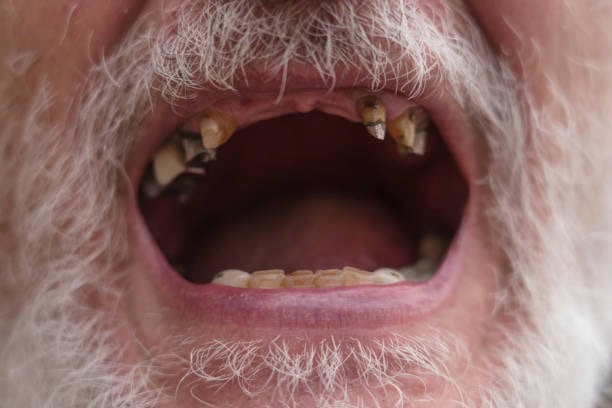 Primo piano di una bocca aperta con denti mancanti e cariati.