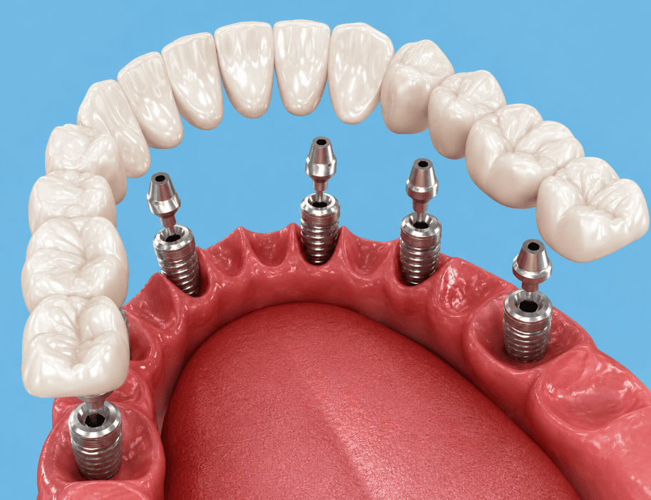 Illustrazione 3D di impianti dentali con denti protesici, che mostra la moderna tecnologia di ripristino orale su uno sfondo blu.