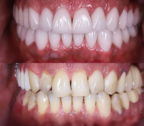 Before and after dental treatment showing improved white teeth and gum health.