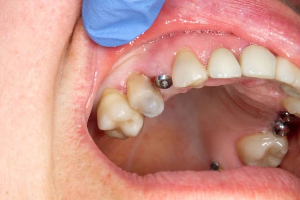 Close-up of dental implants in the upper jaw, highlighting missing teeth and gum structure in a dental checkup setting.