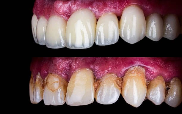 Comparison of healthy vs. decayed teeth showing dental health improvement after treatment.