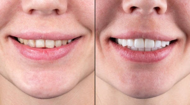 Before and after teeth whitening transformation showcases brighter, healthier smile improvement.