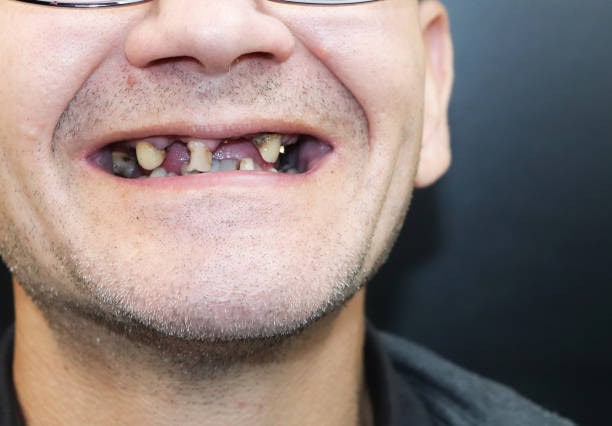Close-up of a person with missing teeth and dental issues, highlighting the need for dental care and oral health solutions.
