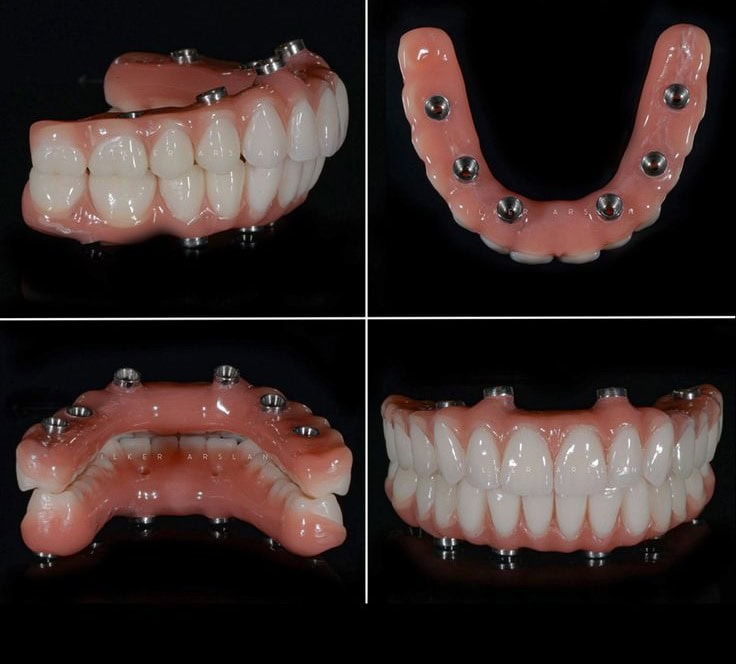 Dental prosthetics showcasing top and bottom arch with implants, ideal for restorative dentistry solutions.