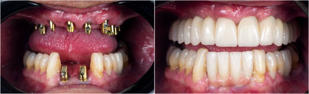 Dental restoration: before and after implant-supported dentures showcasing improved oral aesthetics and functionality.