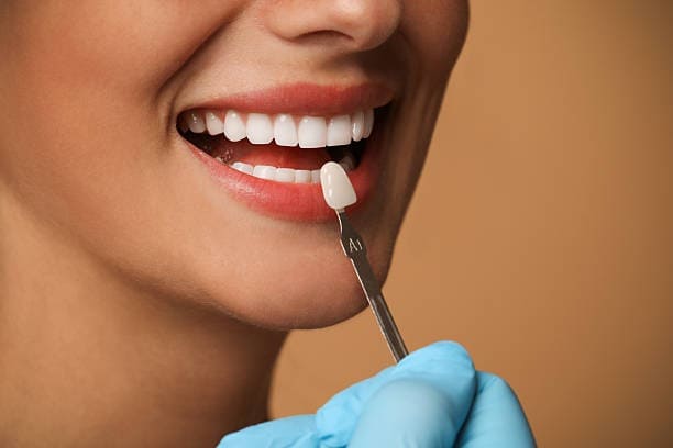 Donna sorridente che riceve l'applicazione di un faccetta dentale da un dentista con guanti, mostrando denti bianchi e il processo di cura dentale.